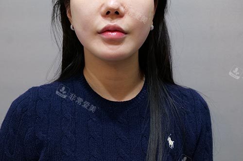 钛提升+韩版<span style=