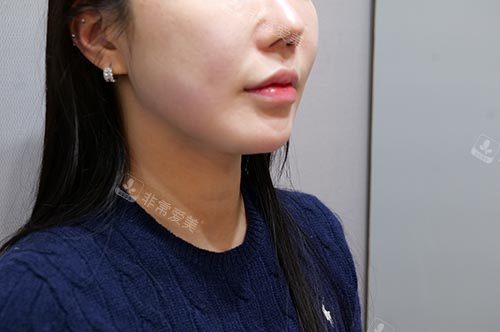 钛提升+韩版<span style=