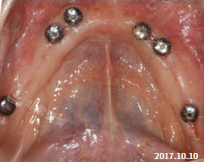 韩国NewYorkWhite牙科术前图