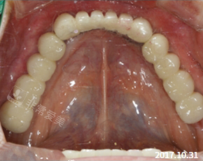 韩国NewYorkWhite牙科术后图