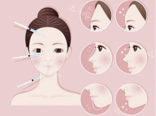 玻尿酸鼻基底填充示意图