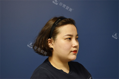 韩国弘大凯特皮肤科轮廓提升后