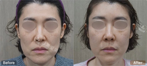 韩国genius皮肤科填充法令纹前后对比图