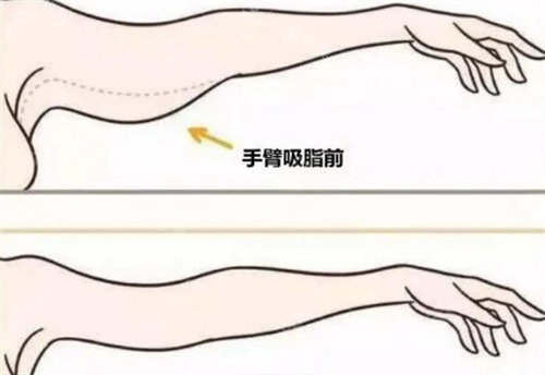 手臂吸脂
