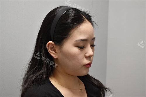 弘大Kate皮肤科实例术前照片