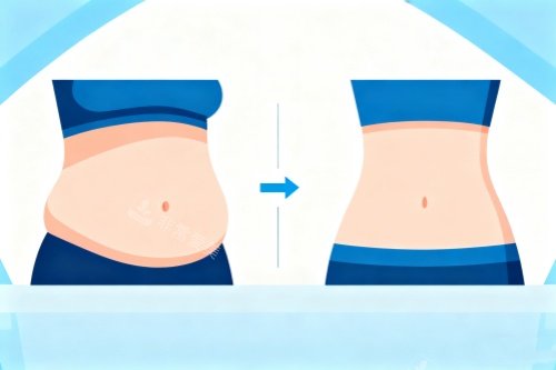 腰腹部做吸脂卡通图