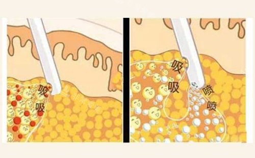 吸脂操作示意图