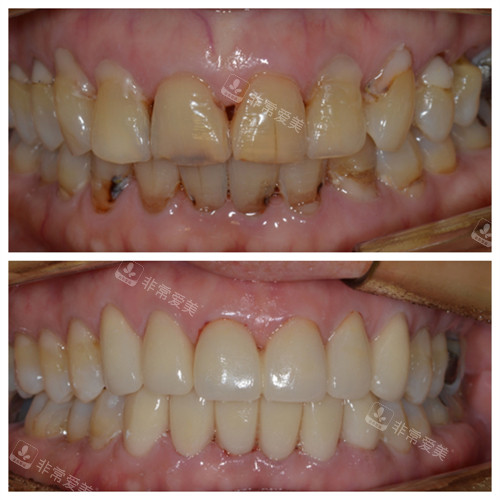 NewYorkWhite牙科牙齒貼面前后對比