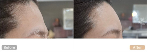 韓國genius整形外科皮膚科額頭填充對比 韓國genius整形外科皮膚科額頭填充對比
