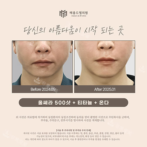 韓國梅宗德皮膚科面部緊致提升實例圖 韓國梅宗德皮膚科面部緊致提升實例圖