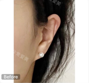釜山Genius皮膚科耳朵填手術(shù)前照片 釜山Genius皮膚科耳朵填手術(shù)前照片