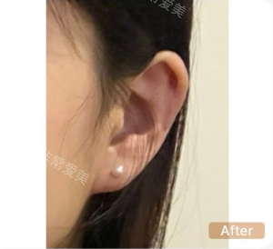 釜山Genius皮膚科耳朵填充手術(shù)后照片 釜山Genius皮膚科耳朵填充手術(shù)后照片