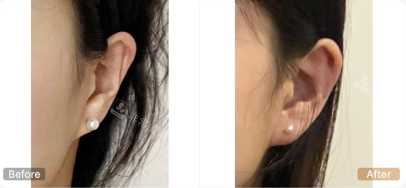 釜山Genius皮膚科耳朵填充前后對(duì)比照片 釜山Genius皮膚科耳朵填充前后對(duì)比照片