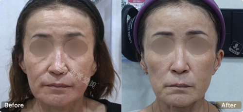 釜山genius皮膚科面部提升對比 釜山genius皮膚科面部提升對比