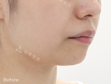 韩国theia 皮肤科治疗后 韩国theia 皮肤科治疗后