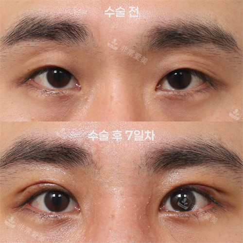 韓國(guó)新整形外科實(shí)例前后對(duì)比