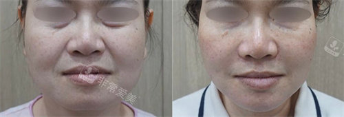 釜山genius皮肤科去法令纹前后对比图