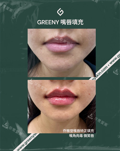 韓國(guó)greeny皮膚科豐唇
