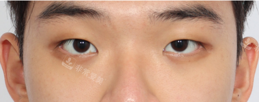 韓國麗爾麗整形外科雙眼皮術前照片