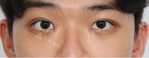 韓國麗爾麗整形外科雙眼皮術后照片