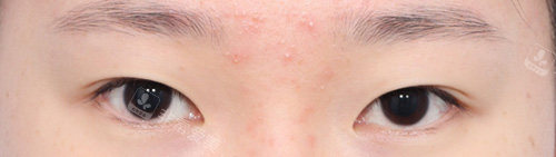韩国丽尔丽整形外科双眼皮前 韩国丽尔丽整形外科双眼皮前