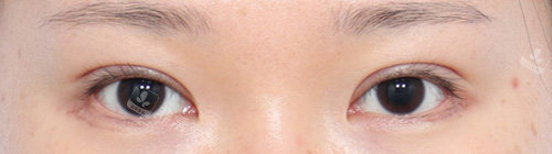 韩国丽尔丽整形外科双眼皮后 韩国丽尔丽整形外科双眼皮后