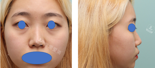 丽尔丽鼻整形前