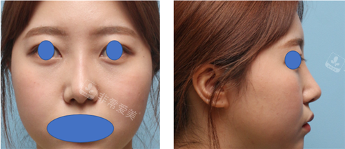 丽尔丽鼻整形后