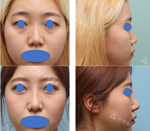 丽尔丽鼻整形前后对比