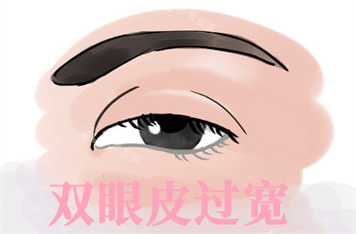 双眼皮过宽修复