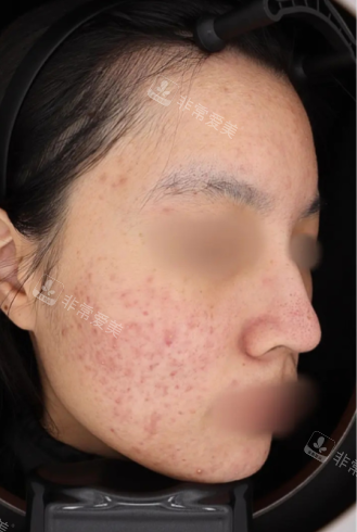 韩国GREENY皮肤科LHALA FILL+黄金微针+外泌体Curejet治疗前 韩国GREENY皮肤科LHALA FILL+黄金微针+外泌体Curejet治疗前