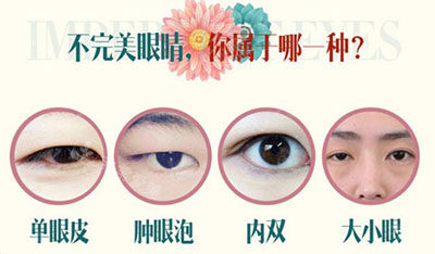 酒泉华美医院双眼皮整形