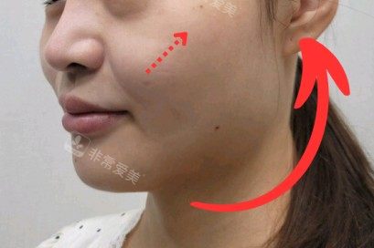 韩国Greeny皮肤科对比图--前