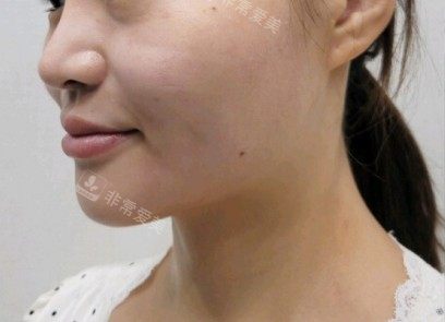 韩国Greeny皮肤科对比图--后