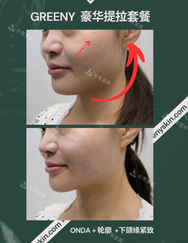 韩国Greeny皮肤科对比图