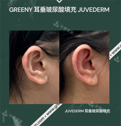 韩国greeny皮肤科耳垂玻尿酸填充前后对比
