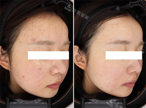 韩国Greeny皮肤科祛痘前后对比图