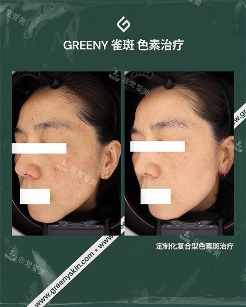 祛斑前后对比