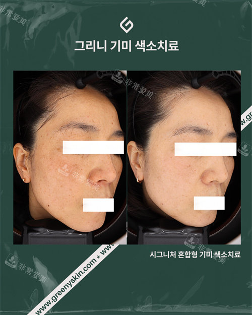 雀斑治疗对比的照片