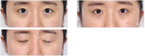 韩国丽尔丽整形外科前后对比 韩国丽尔丽整形外科前后对比