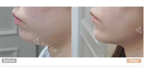 韩国genius皮肤科下巴整形对比照片