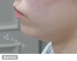韩国genius皮肤科下巴整形术前照片