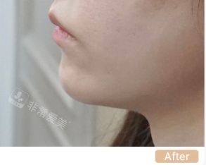韩国genius皮肤科下巴整形术后照片