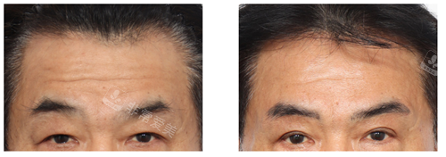 韩国丽尔丽整形外科男性抗衰术例对比