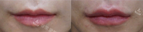 韩国Genius皮肤科嘴唇填充对比图 韩国Genius皮肤科嘴唇填充对比图