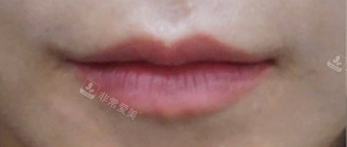 韩国genius皮肤科嘴唇填充前 韩国genius皮肤科嘴唇填充前