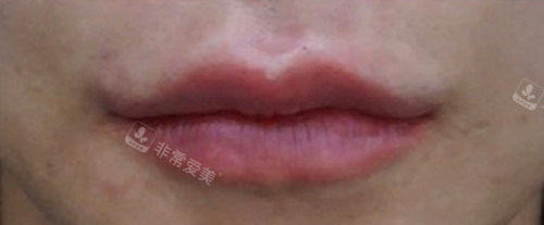 韩国genius皮肤科嘴唇填充后 韩国genius皮肤科嘴唇填充后