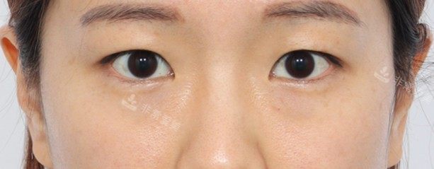 韩国丽尔丽整形外科眼部整形术前图