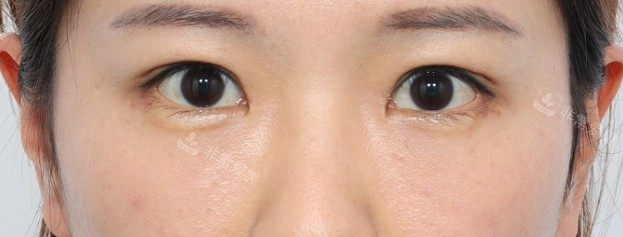 韩国丽尔丽整形外科眼部整形术后图