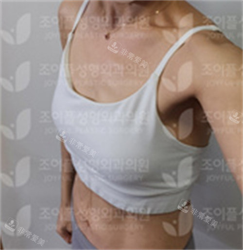 韩国喜悦整形隆胸前图片